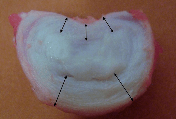 Πώς μοιάζει ένας μεσοσπονδύλιος δίσκος;